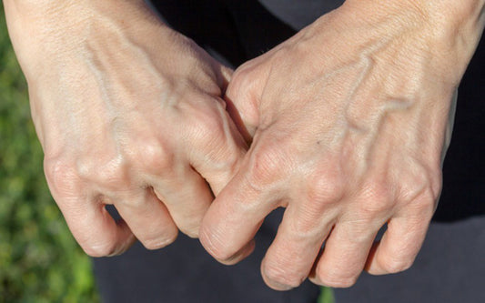 Suy giãn tĩnh mạch tay: Nguyên nhân và cách điều trị ra sao?